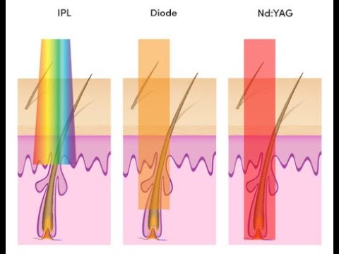 Diode laser verschil met IPL